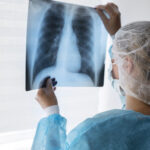 Stewardship antimicrobiano: como o farmacêutico melhora desfechos em pneumonia hospitalar